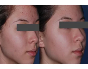 Acne Treatment Cutis Dermatology Brisbane 63