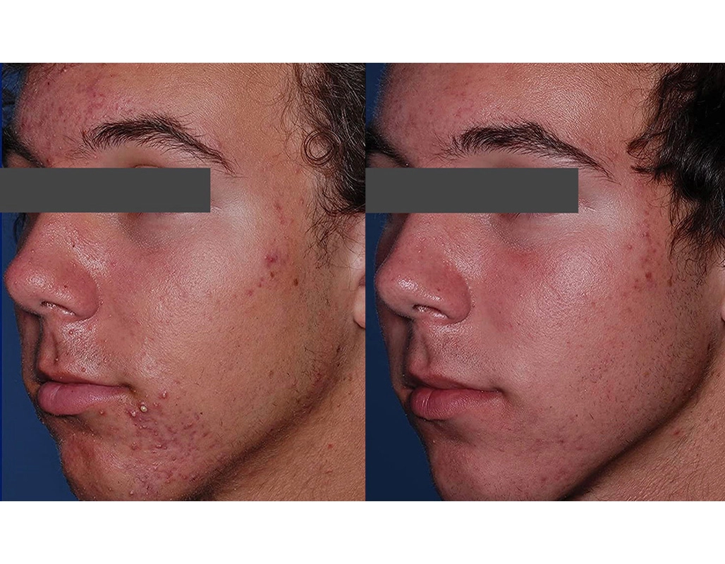 Acne Treatment Cutis Dermatology Brisbane 64