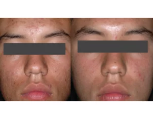 Acne Treatment Cutis Dermatology Brisbane 65