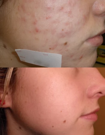 Acne Treatment Cutis Dermatology Brisbane 67