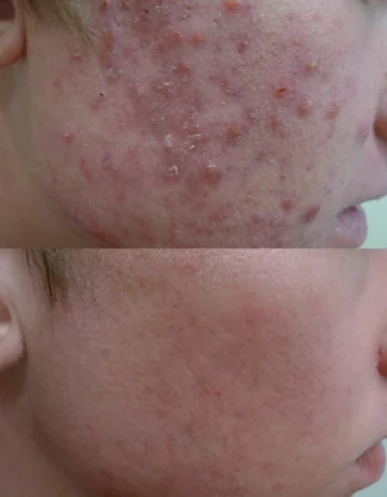 Acne Treatment Cutis Dermatology Brisbane 68