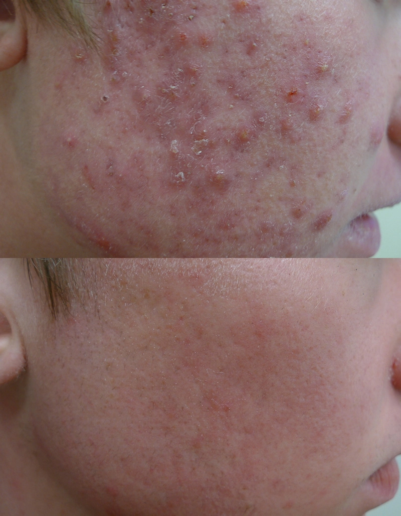Acne Treatment Cutis Dermatology Brisbane 68