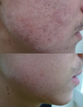 Acne Treatment Cutis Dermatology Brisbane 69