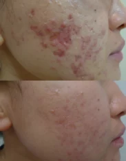 Acne Treatment Cutis Dermatology Brisbane 70