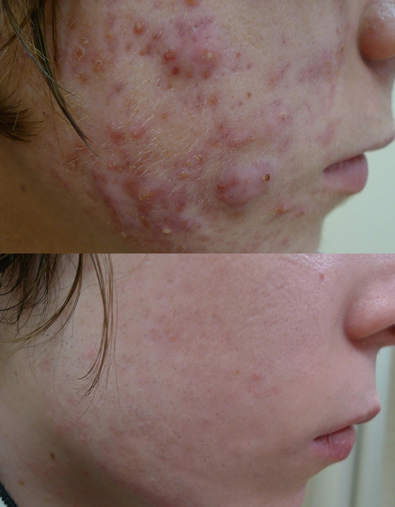 Acne Treatment Cutis Dermatology Brisbane 71