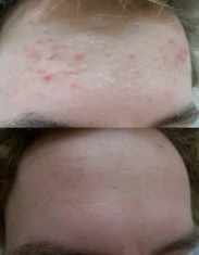 Acne Treatment Cutis Dermatology Brisbane 72