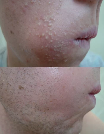 Acne Treatment Cutis Dermatology Brisbane 73