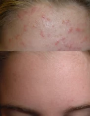 Acne Treatment Cutis Dermatology Brisbane 74