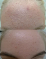 Acne Treatment Cutis Dermatology Brisbane 75