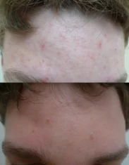 Acne Treatment Cutis Dermatology Brisbane 76