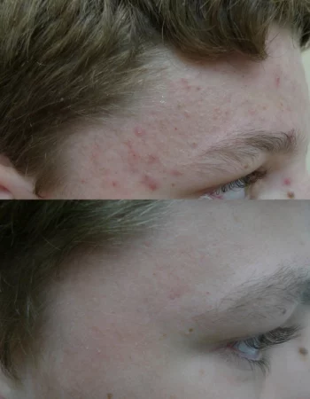 Acne Treatment Cutis Dermatology Brisbane 77