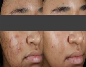 Acne Treatment Cutis Dermatology Brisbane 78