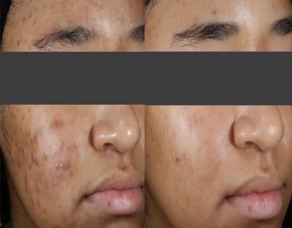 Acne Treatment Cutis Dermatology Brisbane 78