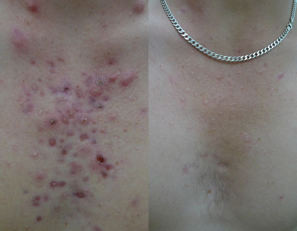 Acne Treatment Cutis Dermatology Brisbane 79