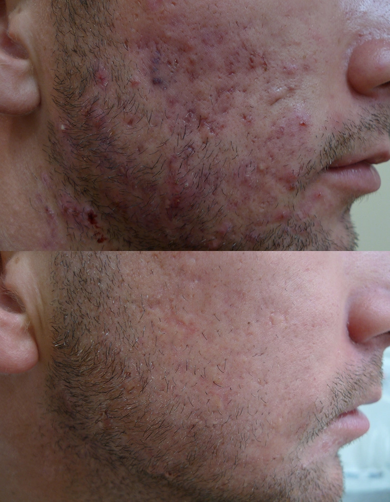Acne Treatment Cutis Dermatology Brisbane 81