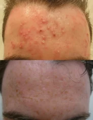 Acne Treatment Cutis Dermatology Brisbane 82