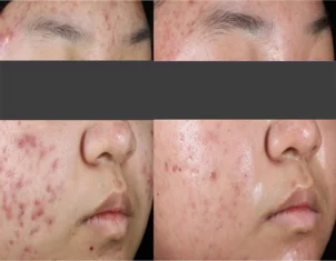 Acne Treatment Cutis Dermatology Brisbane 84