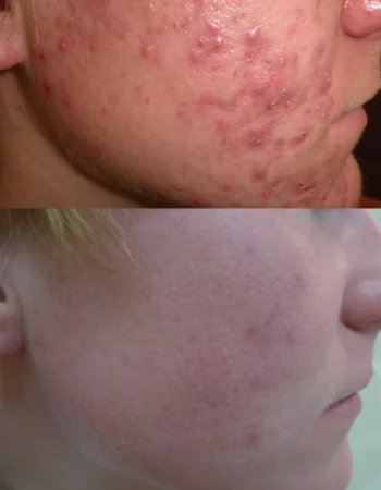 Acne Treatment Cutis Dermatology Brisbane 85