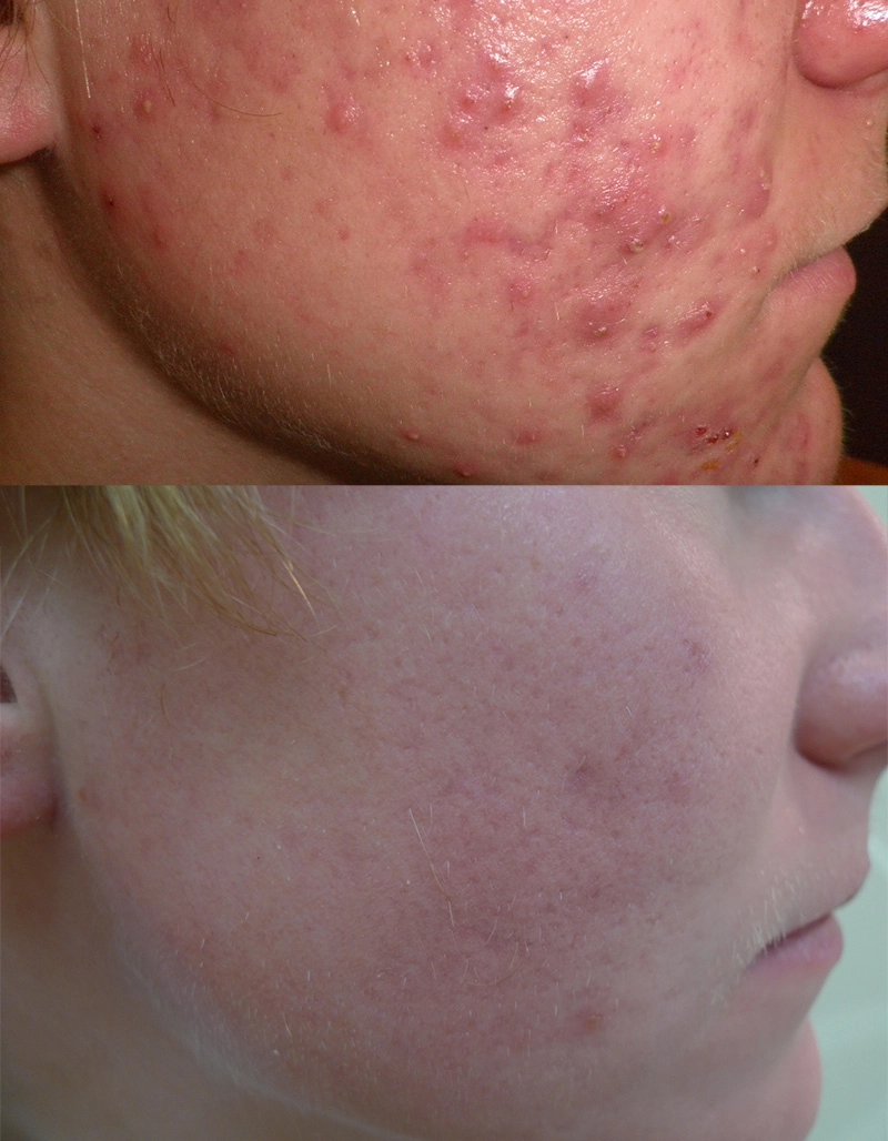 Acne Treatment Cutis Dermatology Brisbane 85