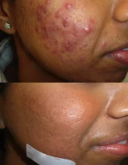 Acne Treatment Cutis Dermatology Brisbane 86