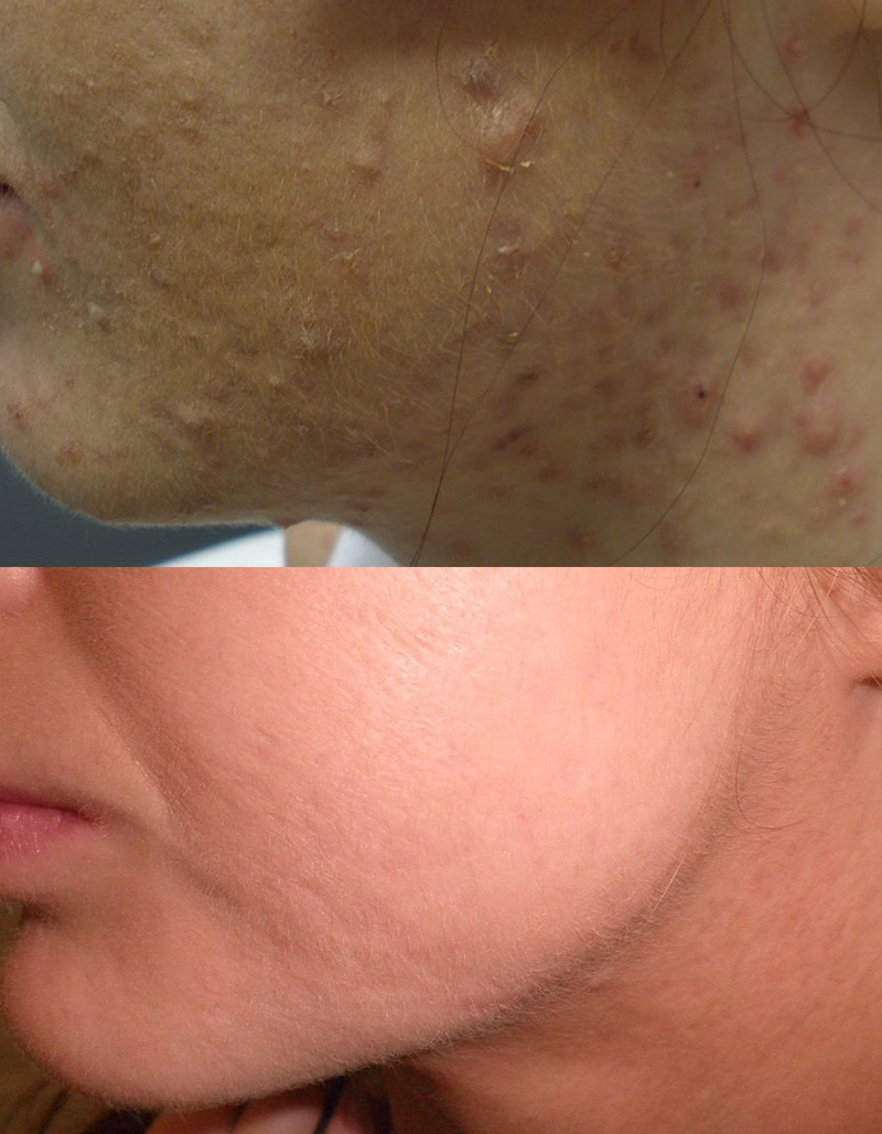 Acne Treatment Cutis Dermatology Brisbane 87