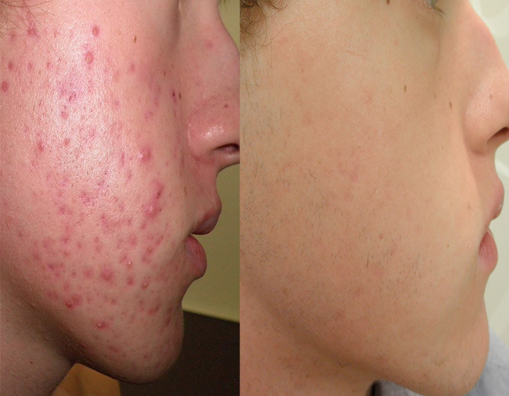 Acne Treatment Cutis Dermatology Brisbane 88
