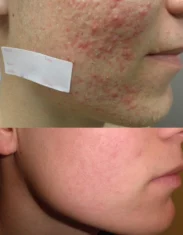 Acne Treatment Cutis Dermatology Brisbane 89