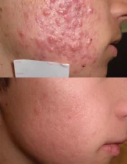 Acne Treatment Cutis Dermatology Brisbane 90