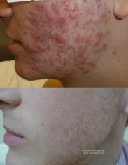 Acne Treatment Cutis Dermatology Brisbane 91