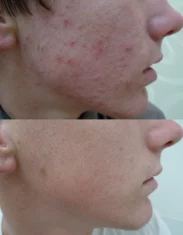 Acne Treatment Cutis Dermatology Brisbane 94