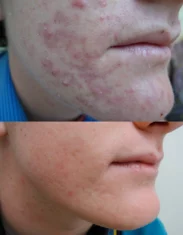 Acne Treatment Cutis Dermatology Brisbane 95