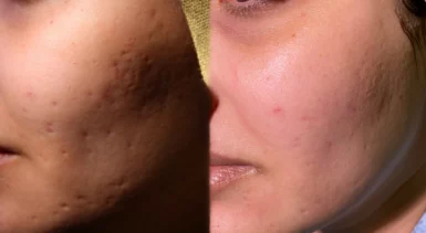 Acne scars treatment cutis dermatology brisbane 10