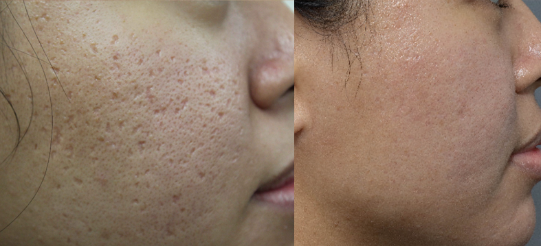 Acne scars treatment cutis dermatology brisbane 11