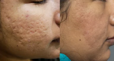 Acne scars treatment cutis dermatology brisbane 12