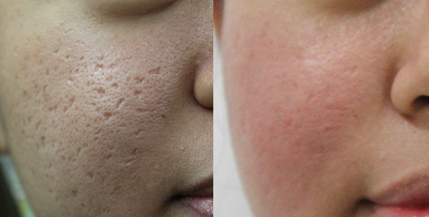 Acne scars treatment cutis dermatology brisbane 13