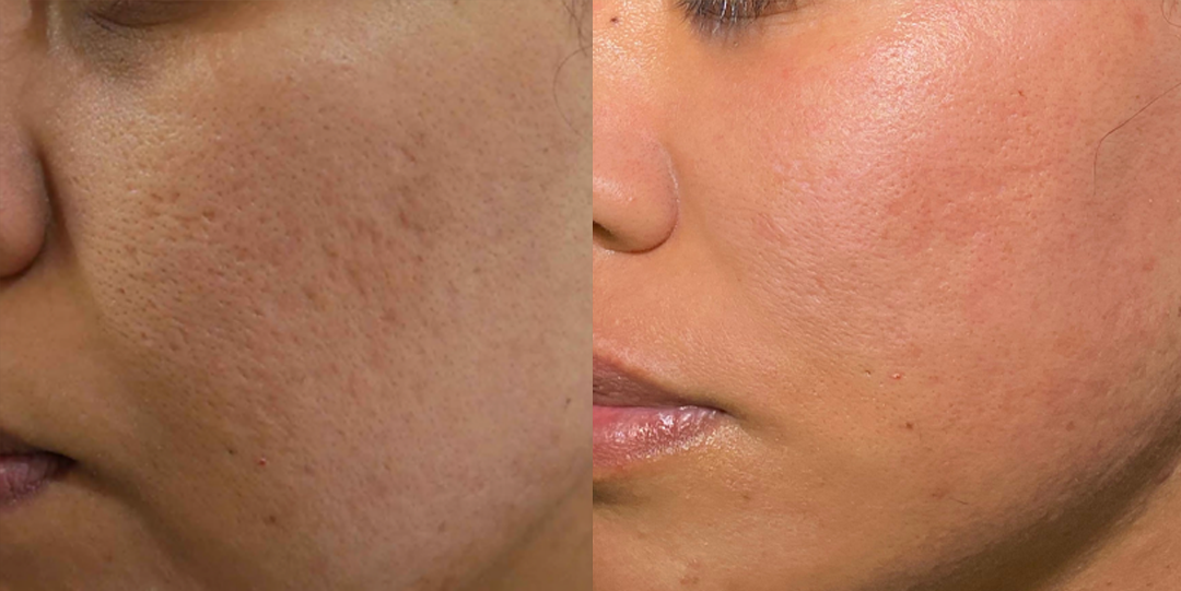 Acne scars treatment cutis dermatology brisbane 14