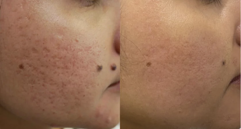 Acne scars treatment cutis dermatology brisbane 15