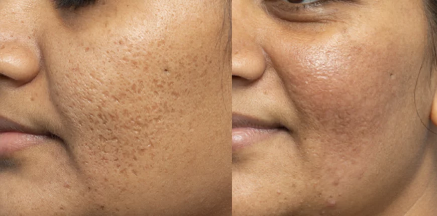 Acne scars treatment cutis dermatology brisbane 16