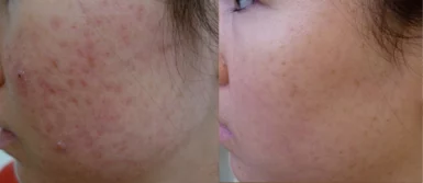 Acne scars treatment cutis dermatology brisbane 17