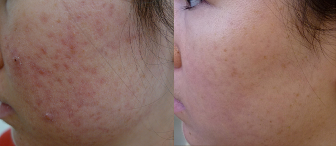 Acne scars treatment cutis dermatology brisbane 17