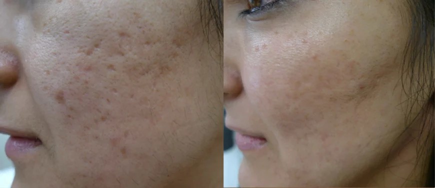 Acne scars treatment cutis dermatology brisbane 18
