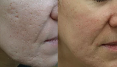 Acne scars treatment cutis dermatology brisbane 19