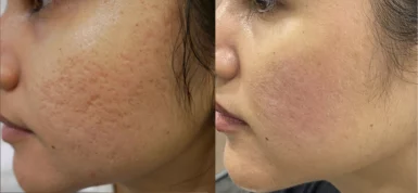 Acne scars treatment cutis dermatology brisbane 23