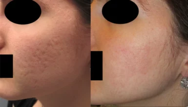 Acne scars treatment cutis dermatology brisbane 25