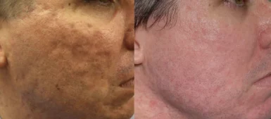 Acne scars treatment cutis dermatology brisbane 27
