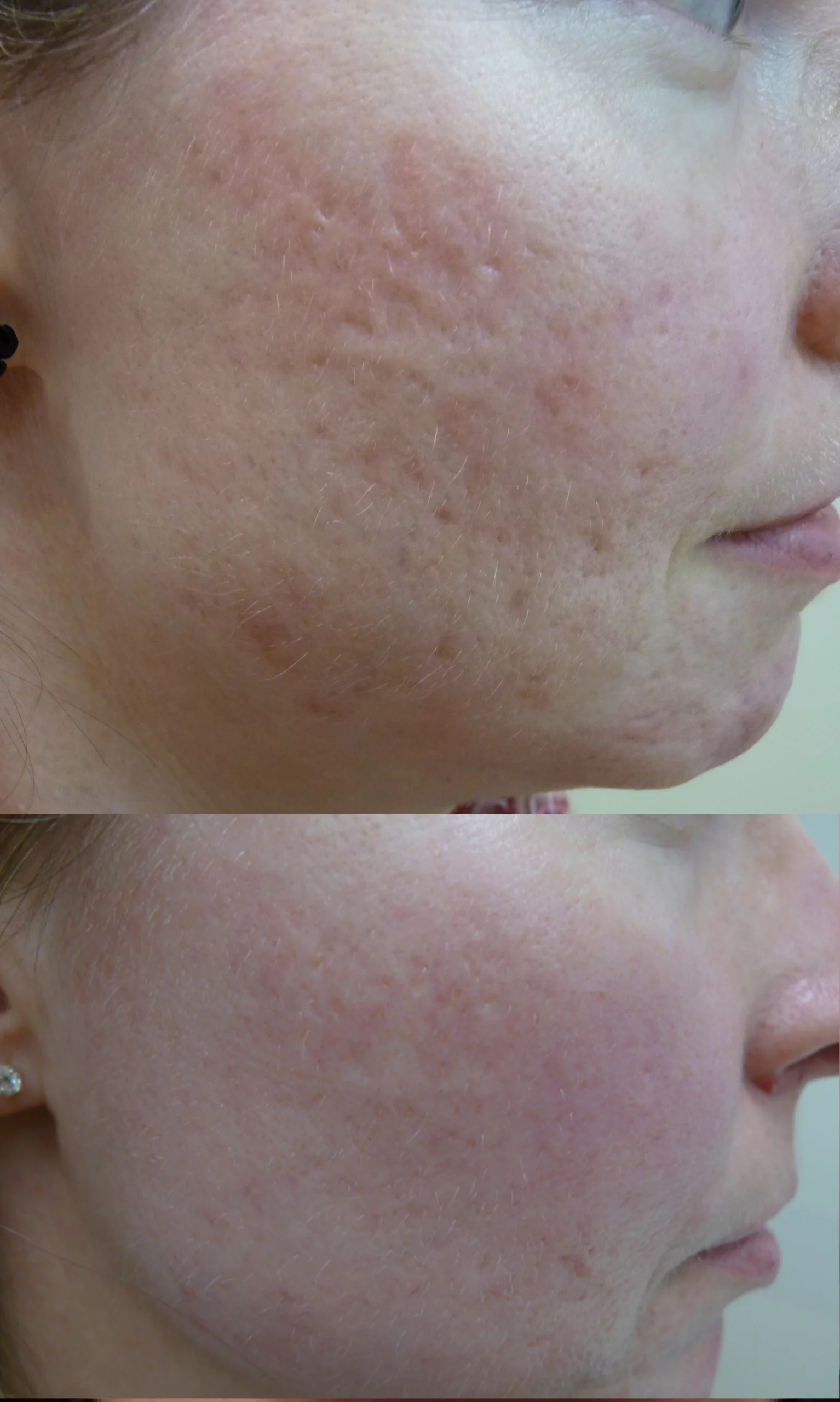 Acne scars treatment cutis dermatology brisbane 29 scaled