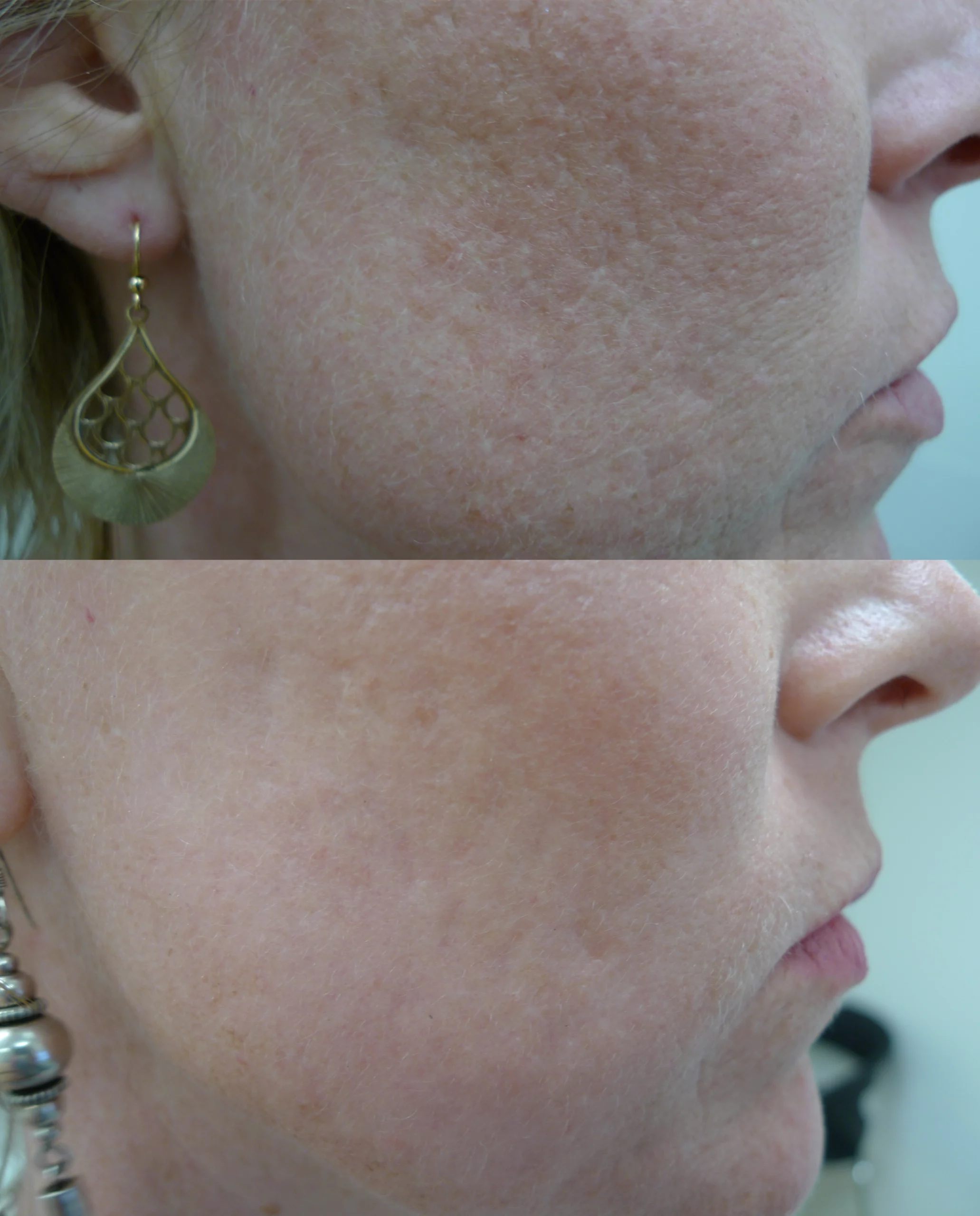 Acne scars treatment cutis dermatology brisbane 30 scaled