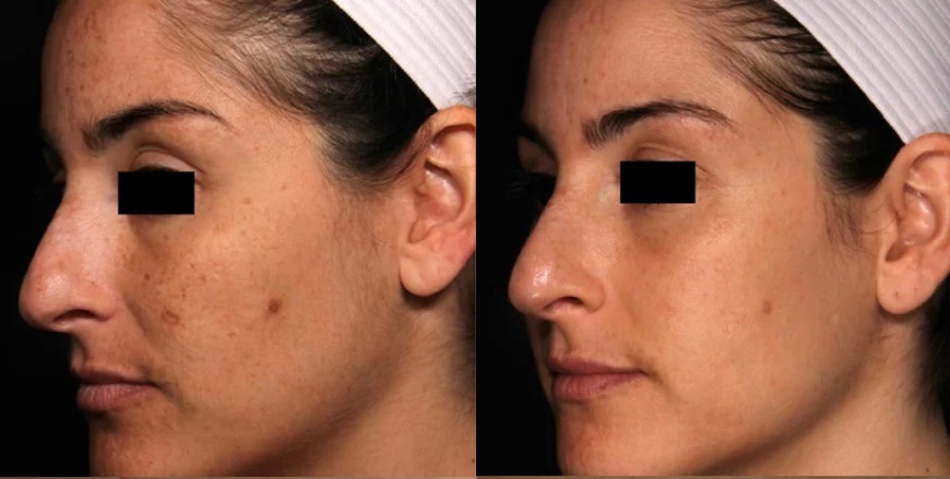 Acne scars treatment cutis dermatology brisbane 32 1