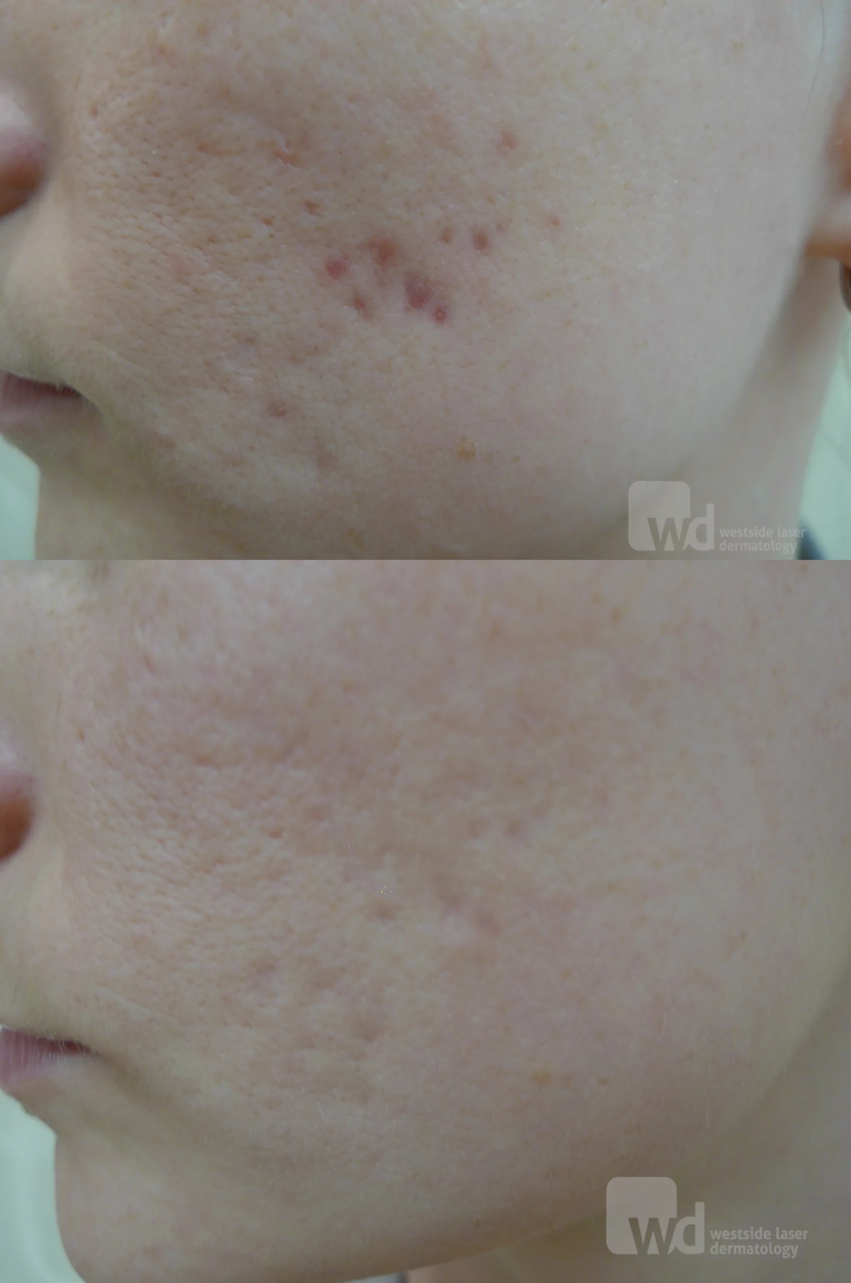 Acne scars treatment cutis dermatology brisbane 32 scaled