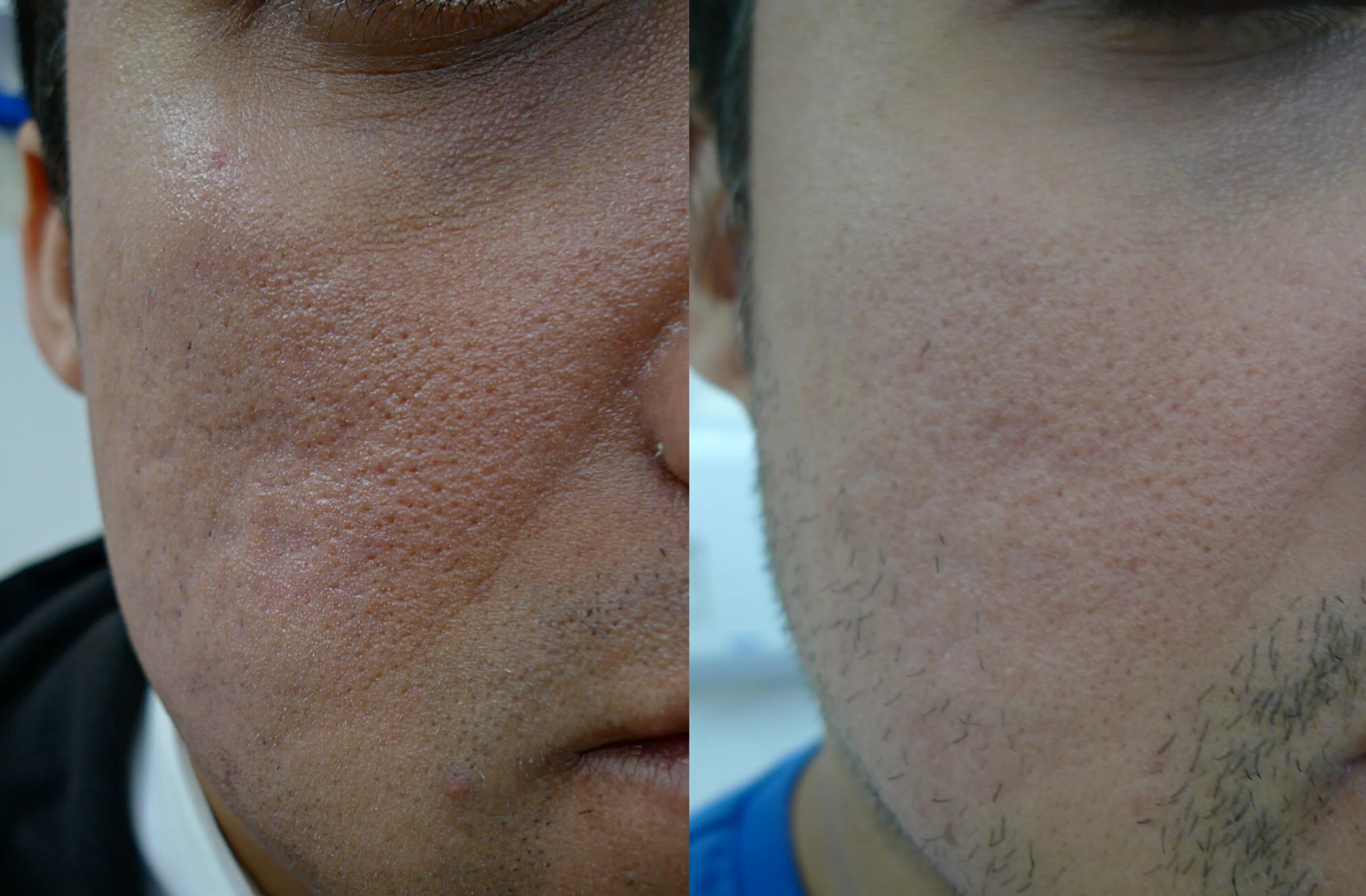 Acne scars treatment cutis dermatology brisbane 34 scaled